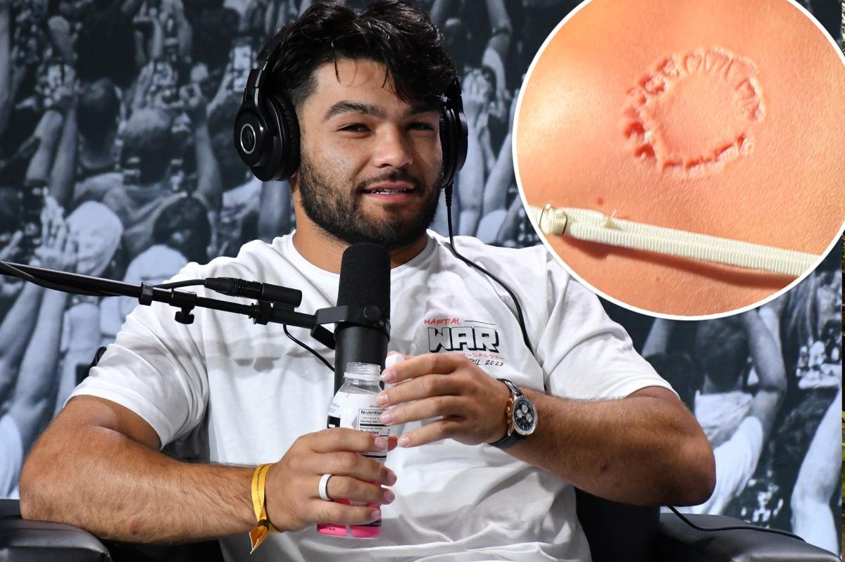 Read more about the article Horrific new photo shows extent of Puka Nacua bite victim’s alleged injury