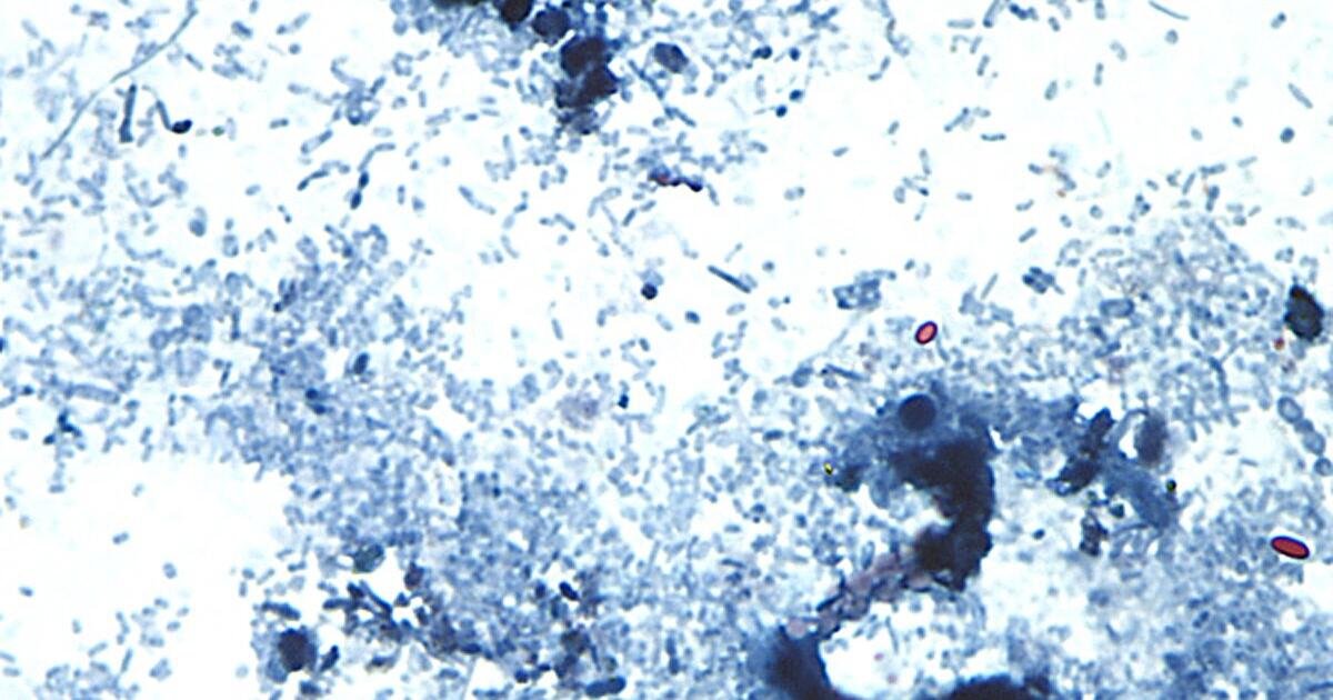 Read more about the article Outbreak of diarrhea-causing parasite grows to more than 1,000 cases