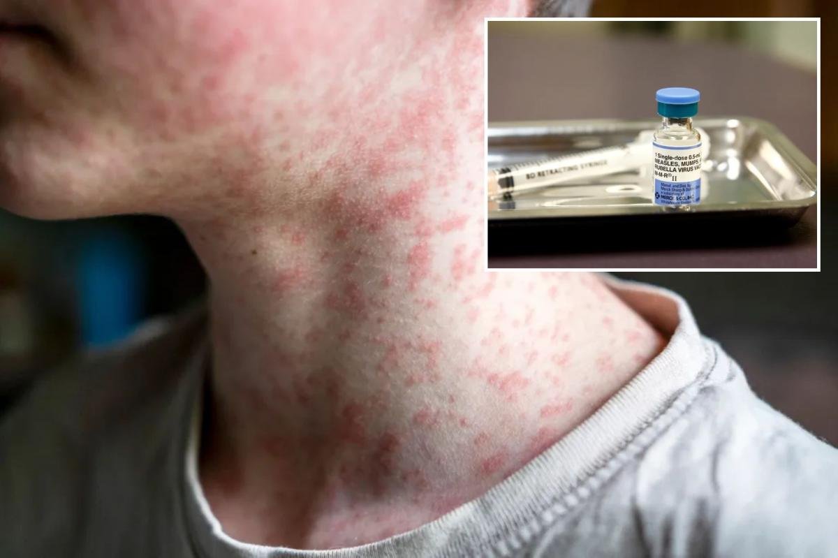 You are currently viewing US hits most cases of âworldâs most contagious diseaseâ in 35 years â and it’s only July