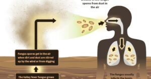 Read more about the article New drug could help people stricken with Valley Fever