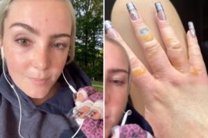 Read more about the article NYC woman warns against getting painful, blistering  ‘Margarita Burn’ by avoiding this common summer activity
