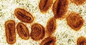 Read more about the article Clade I Mpox case diagnosed in San Diego County after travel abroad