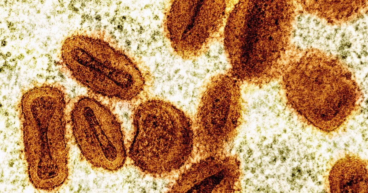 You are currently viewing Clade I Mpox case diagnosed in San Diego County after travel abroad