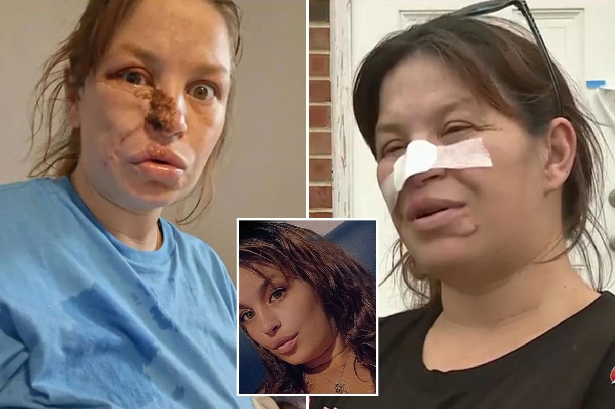 You are currently viewing Pregnant woman needed ‘face put back together’ after savage attack by neighbor’s pit bulls: ‘Almost cost three lives’
