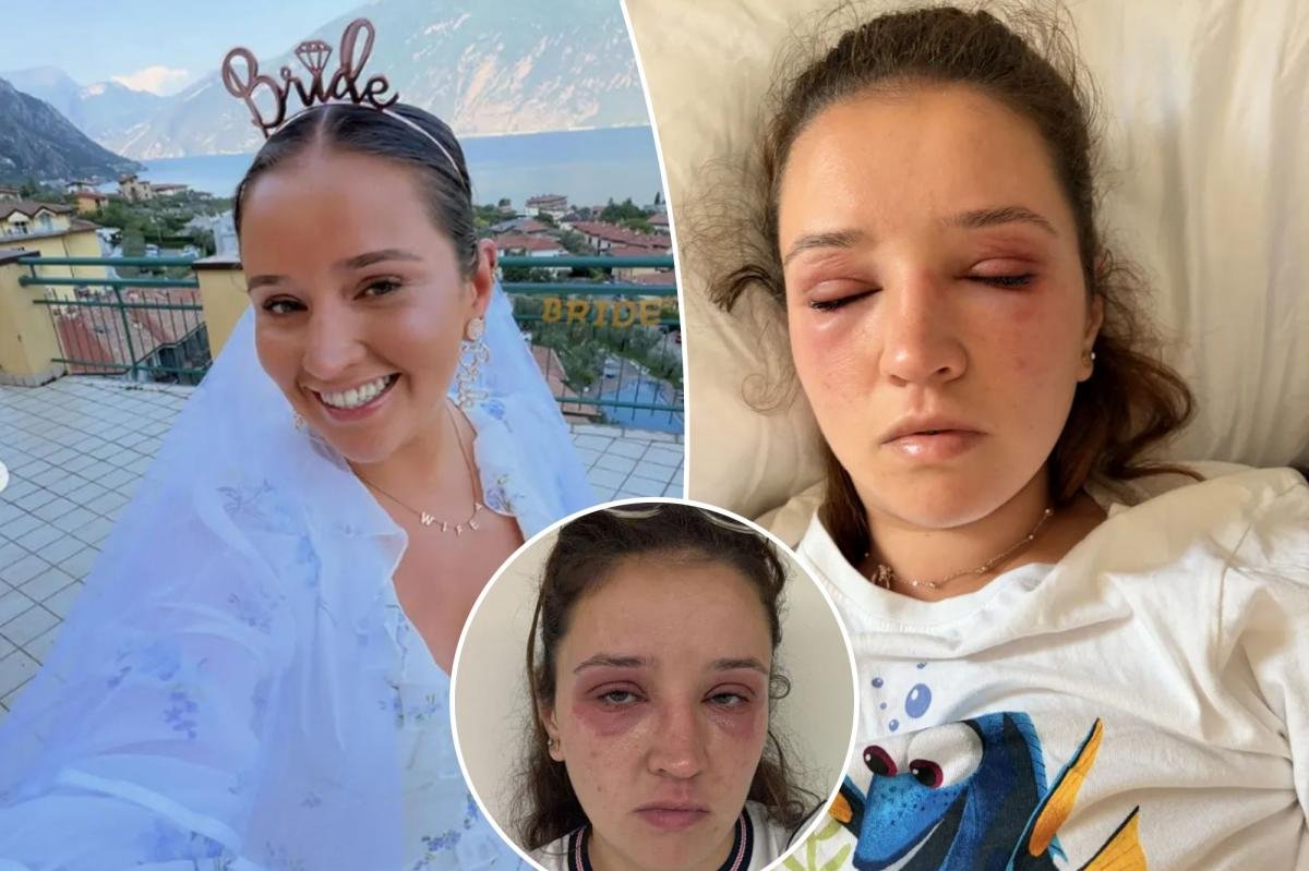 You are currently viewing Bride-to-be sounds alarm after popular beauty treatment left her disfigured before the big day
