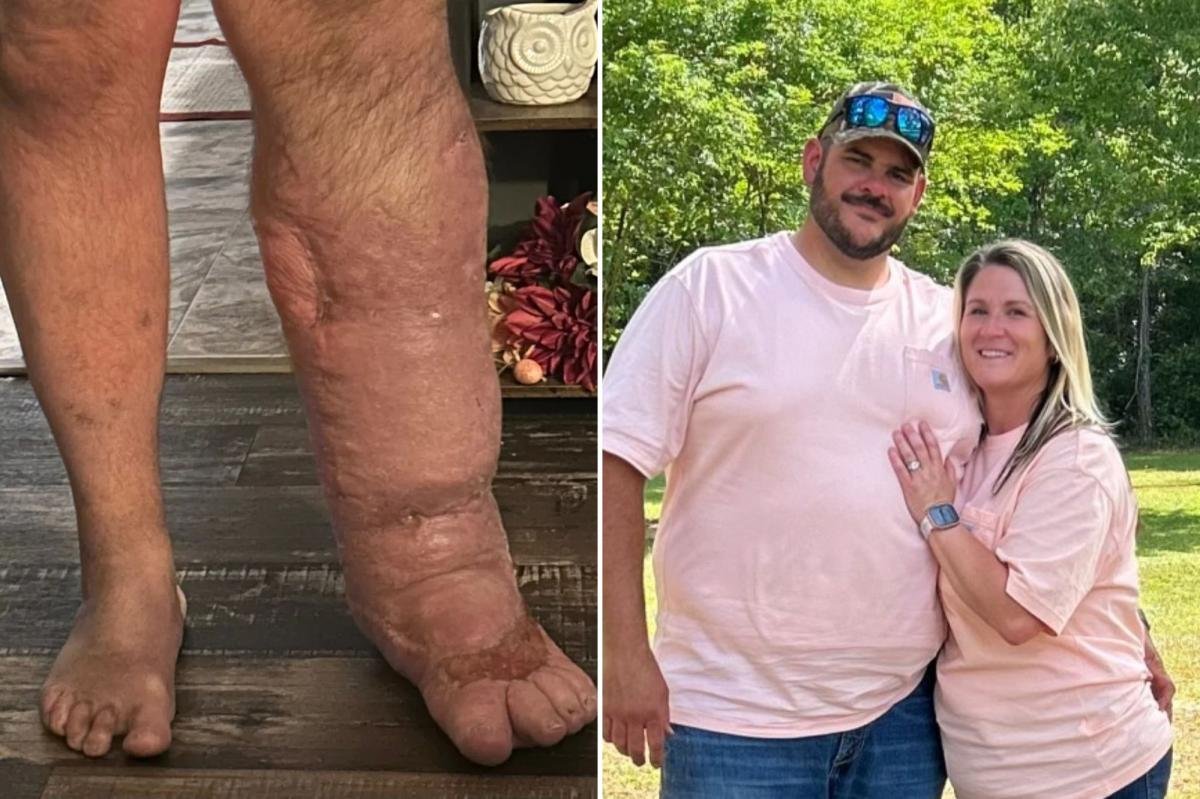 You are currently viewing Horrifying reality of flesh-eating bacteria that caused Florida man’s leg to swell to 8 times its size