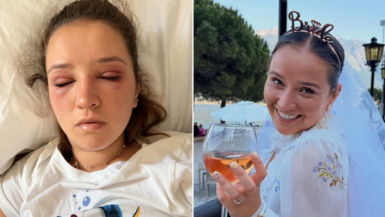 You are currently viewing Bride gets severe allergic reaction to eyelash extensions before wedding